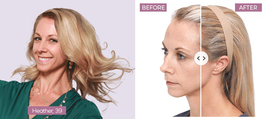 Keranique® Hair Regrowth System real woman hair results